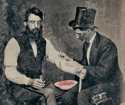 Bloodletting Photo from the Burns Archive